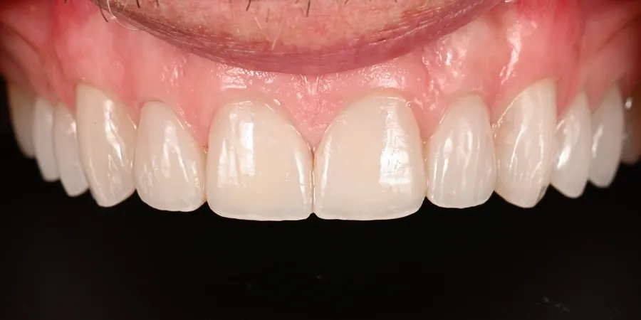 After: Even, brighter upper front teeth.