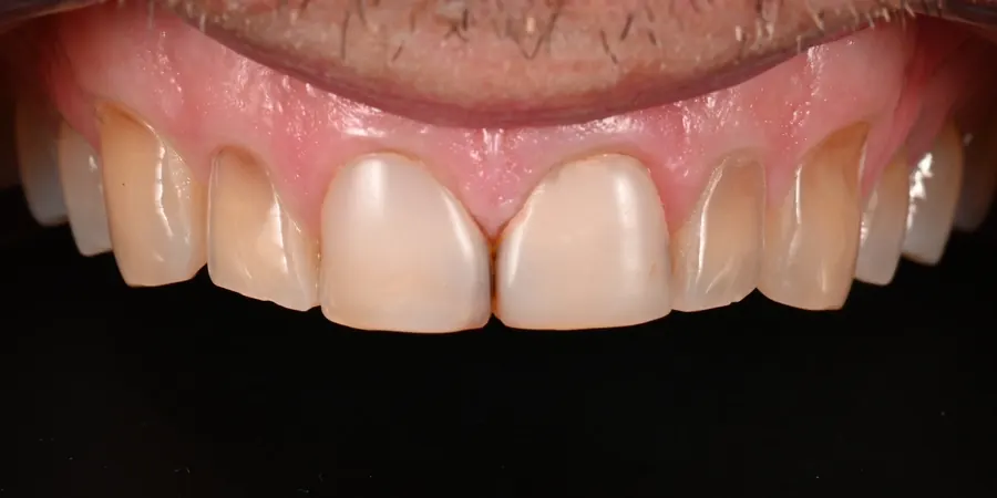 Before: Discoloured, uneven upper front teeth.