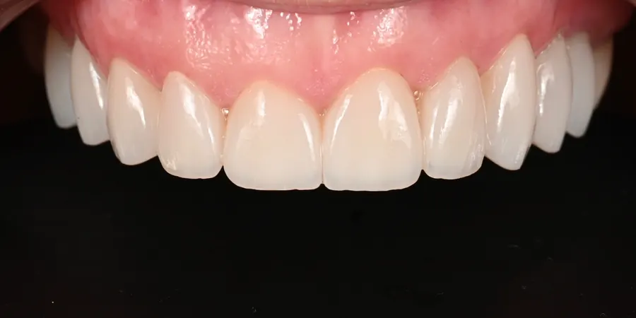 After: A full, even row of light upper teeth.