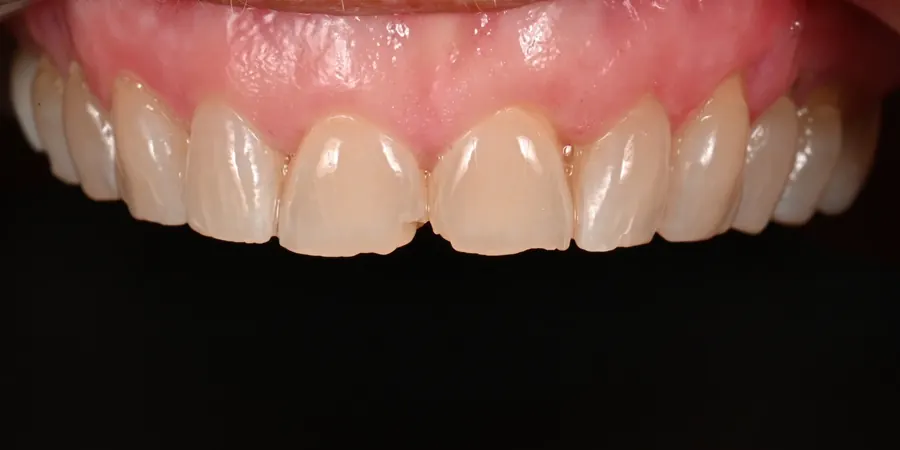 Before: Worn, darker upper front teeth with a gap between the centrals.