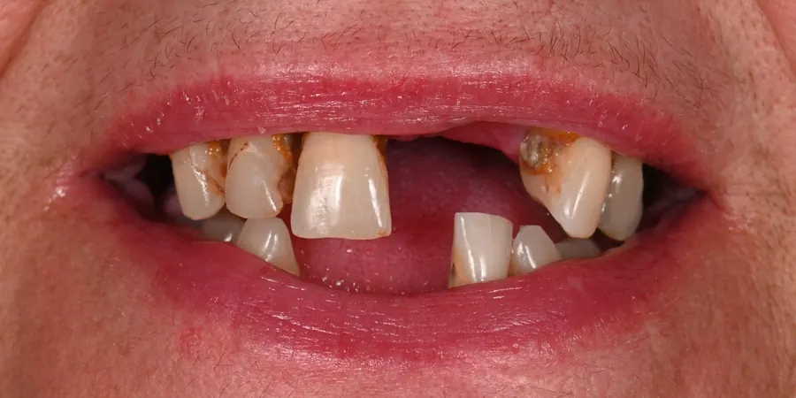 Before: Several missing and broken teeth.