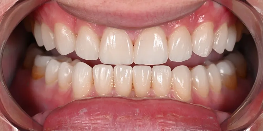 After: Evenly shaped, lighter teeth, upper and lower.