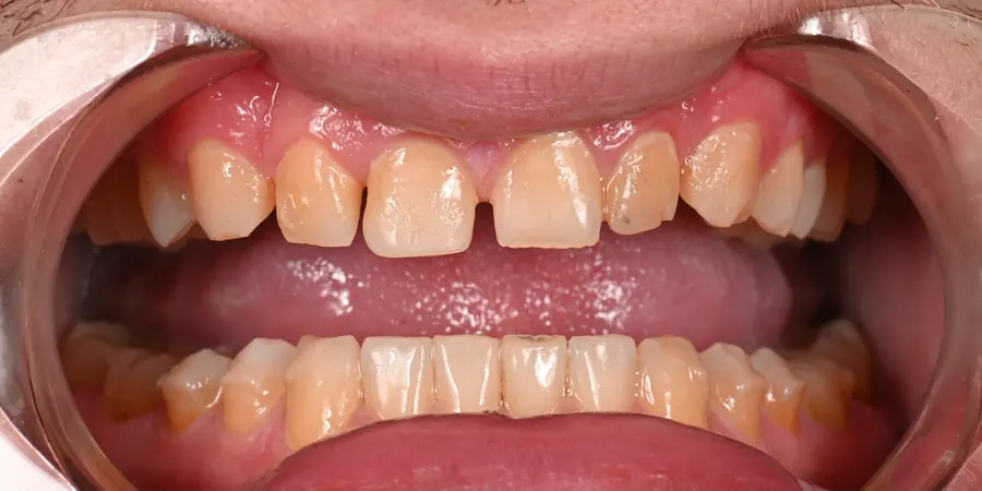 Before: Stained teeth with spaces between them, upper and lower.