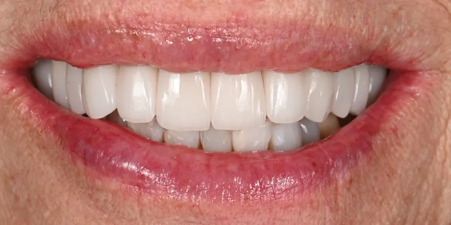 After: An even, aligned smile.