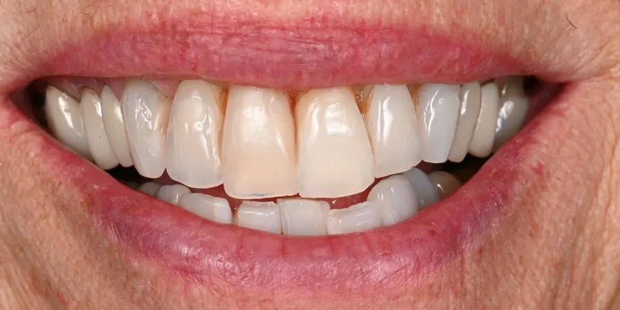 Before: Uneven front teeth with one tooth standing out.