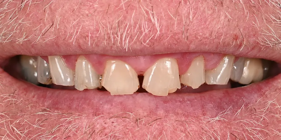 Before: Short, worn and chipped front teeth.